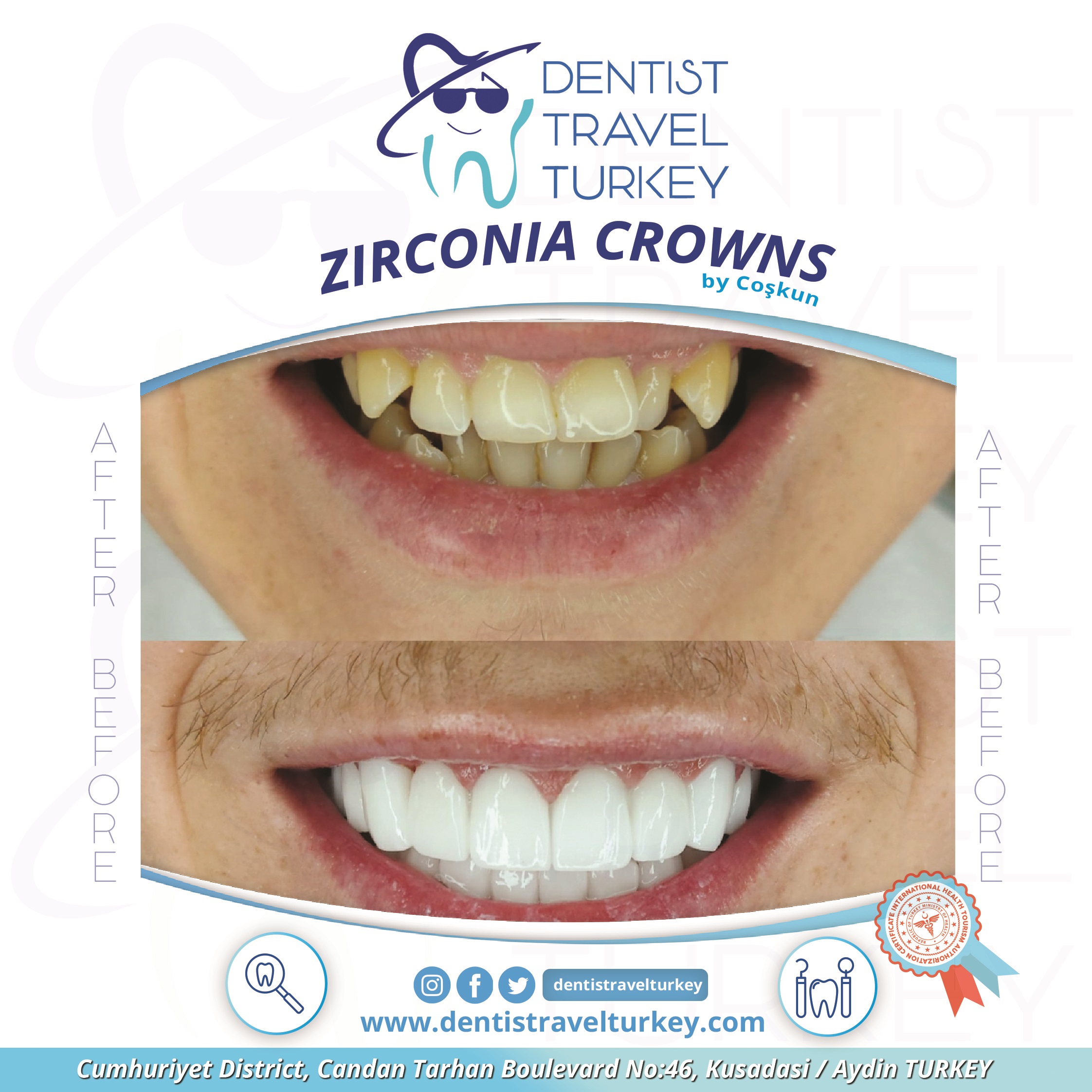 CAN ZIRCONIA CROWNS CAUSE BAD BREATH?