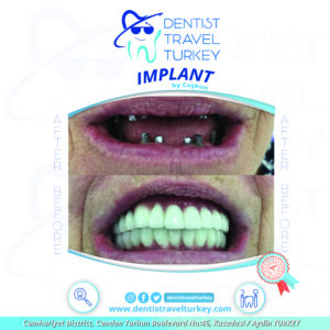 DENTAL IMPLANT HEALING STAGES Picture