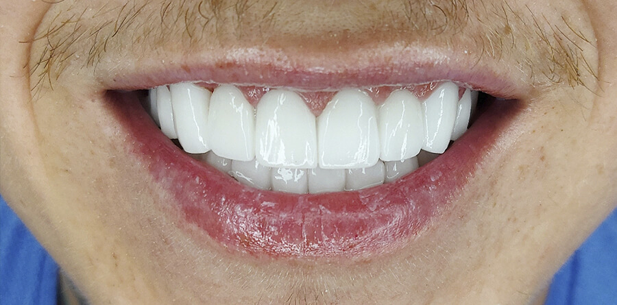 HOW MUCH DOES ALL ON 4 DENTAL IMPLANT APPLICATION COST IN TURKEY?