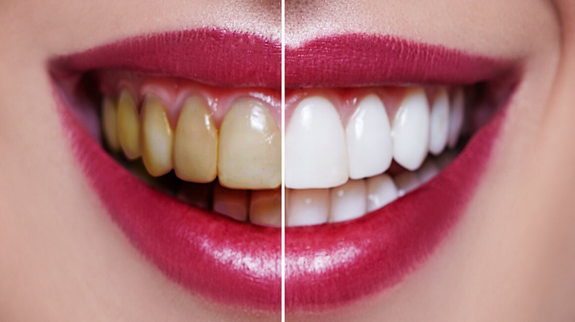 DO YOU WANT TO GET PORCELAIN DENTAL VENEERS IN A DENTAL CENTRE TURKEY?