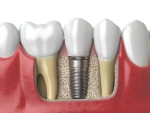 SAME DAY DENTAL IMPLANTS IN TURKEY Picture
