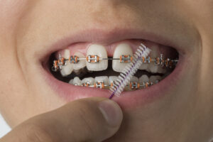 BRACES COLORS IDEAS Picture