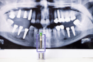 HOW LONG DOES IMPLANT TREATMENT TAKE? Picture