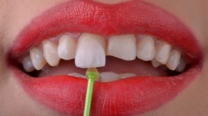 HOW MUCH DOES A DENTAL SIMLE MAKEOVER COST IN TURKEY? Picture