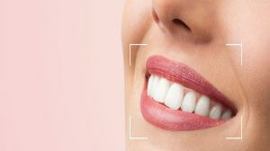 THE FACTORS THAT AFFECT THE FULL SET OF VENEERS’ COSTS IN TURKEY Picture