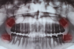 WISDOM TOOTH EXTRACTION Picture