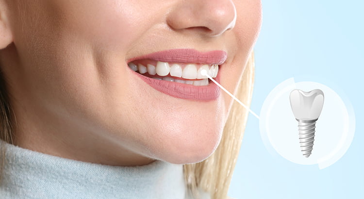 Dental Implants in Turkey: Affordable, Safe & Long-Lasting Tooth Replacement