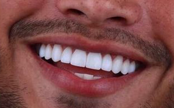 ALL ON 4&6 DENTAL IMPLANTS TURKEY