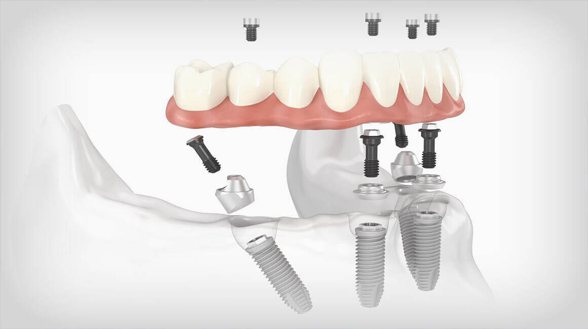 SAME DAY DENTAL IMPLANTS TURKEY