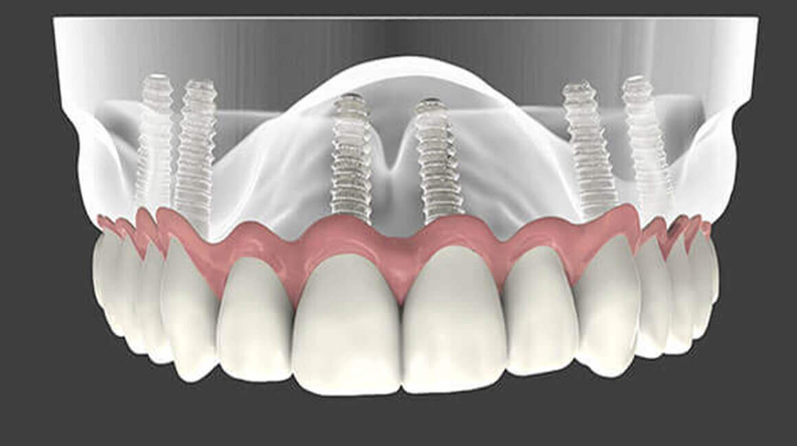 ALL ON 4&6 DENTAL IMPLANTS TURKEY