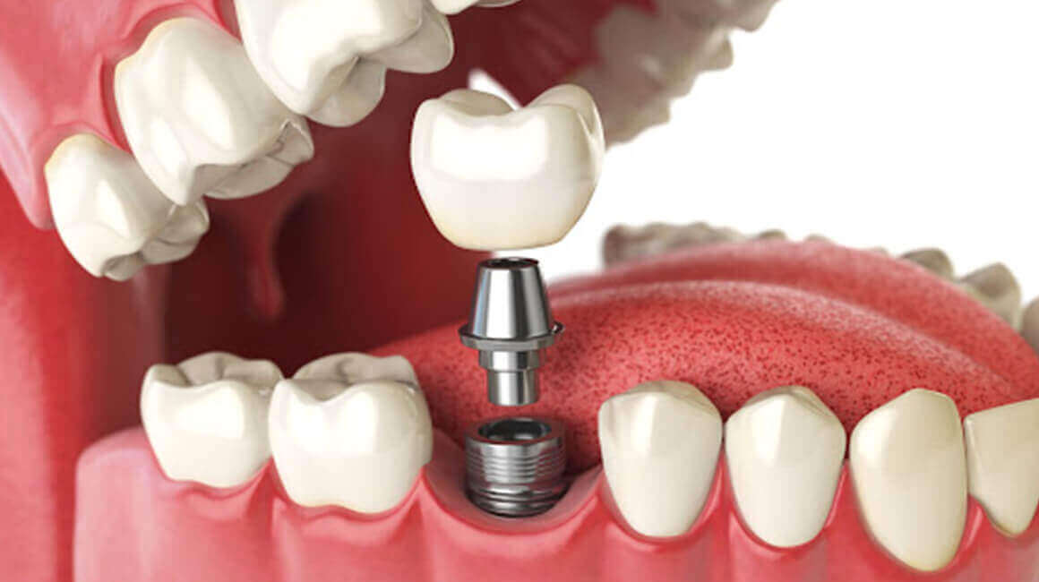 Dental Implants