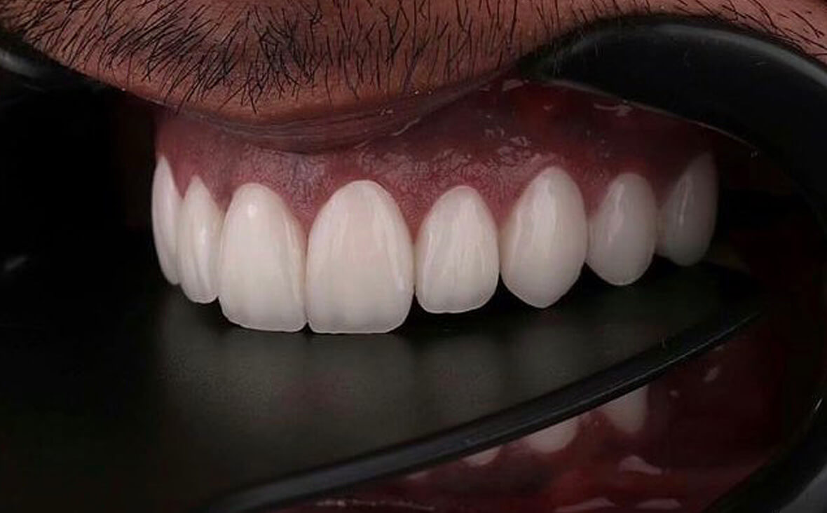 تركيبات الأسنان في تركيا 