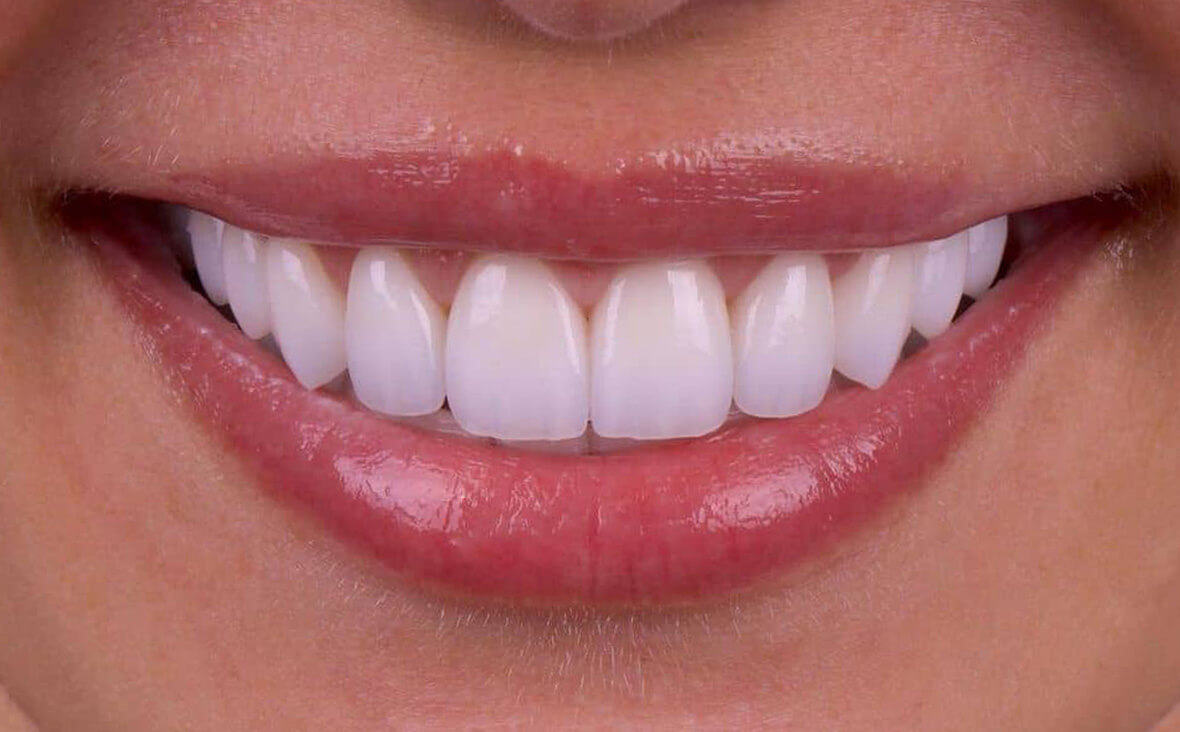 PORCELAIN CROWNS IN TURKEY