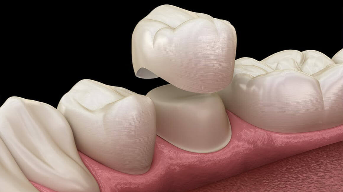 PORCELAIN CROWNS IN TURKEY