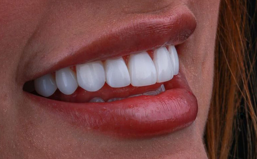 ZIRCONIA CROWNS IN TURKEY