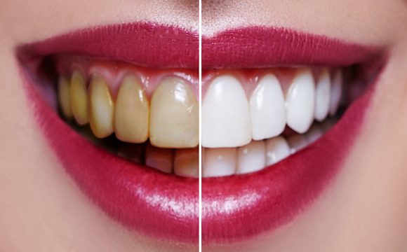 &+#1575;بتسامة هوليوود في تركيا
